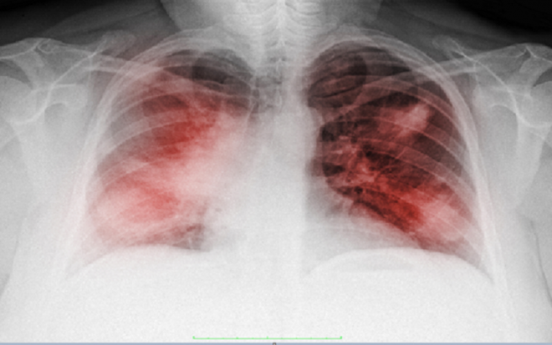 علامات السرطان التي تنسب لأعراض كورونا