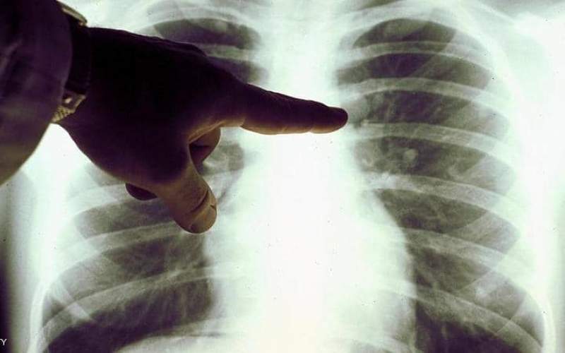 عملية زرع رئة لمصابة بكورونا تنقذ حياتها