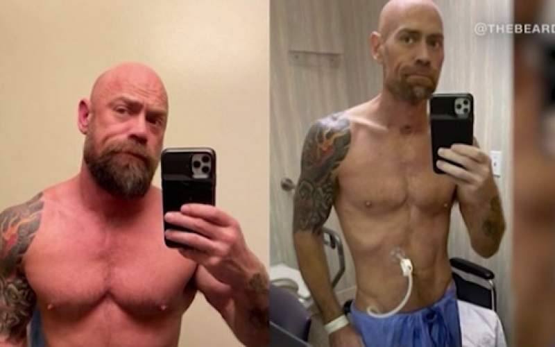 أحد الناجين من فيروس كورونا ينشر صورة صادمة قبل وبعد المرض