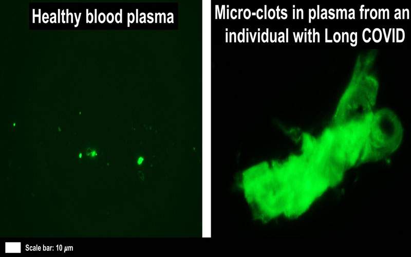 اكتشاف أول دليل على حدوث جلطات دقيقة التهابية في دماء مرضى كورونا طويل الأمد