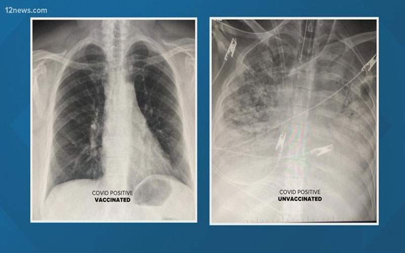 الأشعة السينية تكشف عن الفرق الهائل الذي تحدثه لقاحات 