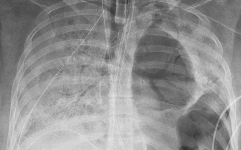 نجاح عملية لزراعة رئتين لمصابة بفيروس كورونا في أميركا 
